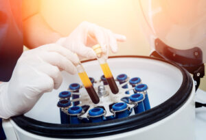 Blood is processed to separate platelet rich plasma for the prp treatment 
